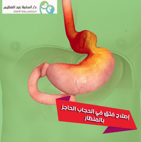 فتق الحجاب الحاجز