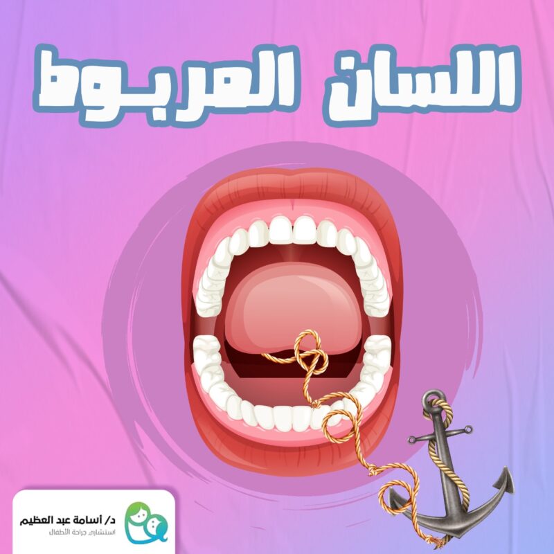 اللسان المربوط عند الاطفال