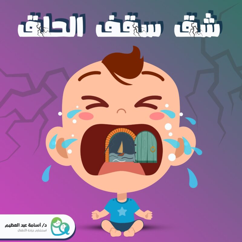 سقف الحلق المشقوق