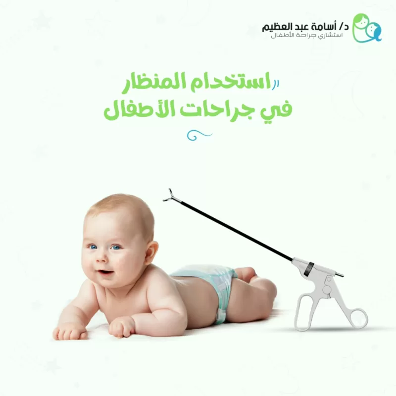 استخدام المنظار فى جراحات الاطفال