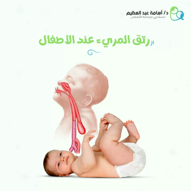 رتق المريء عند الأطفال