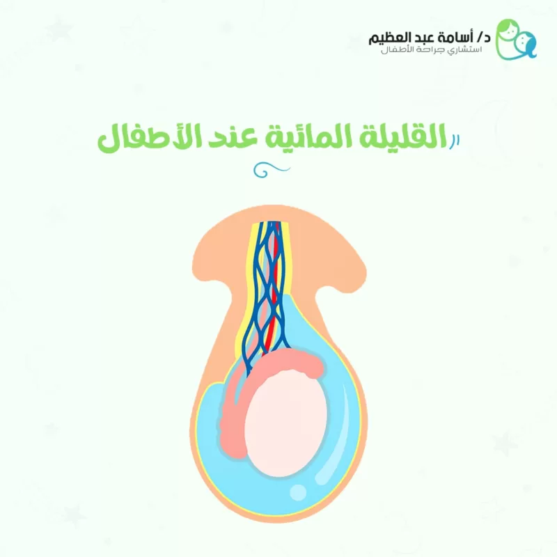 القيلة المائية لدى الأطفال